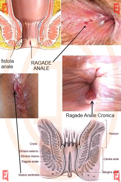 Ragadi Anali Gastroenterologia Endoscopia Digestiva Studio