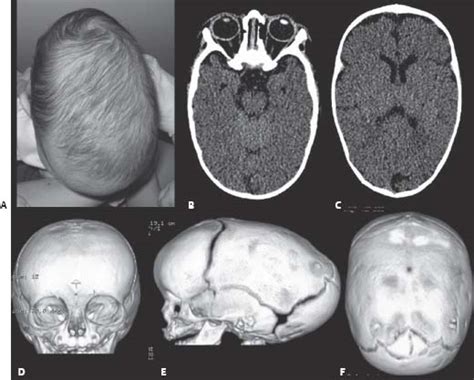 Scaphocephaly Neupsy Key