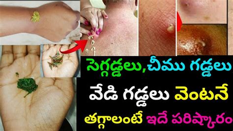 సెగ గడ్డలు చీము గడ్డలు వేడిగడ్డలు How To Get Rid Of Boils Sega