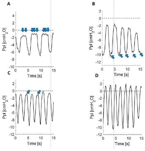 Jcm Free Full Text Pleural Pressure Pulse In Patients With Pleural