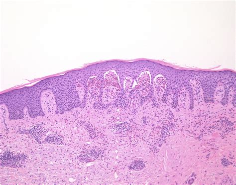 Junctional Epidermolysis Bullosa Histology