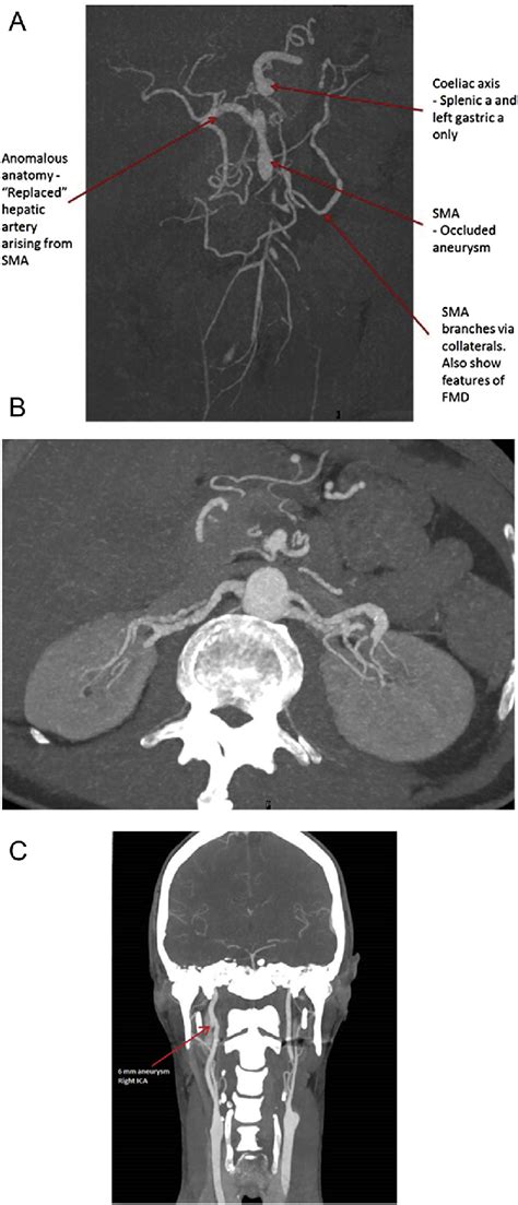 A Computed Tomography Angiography Reconstruction Showing Aberrant Download Scientific Diagram