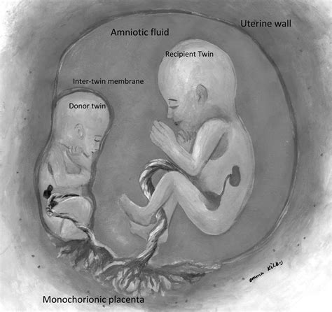 What Is Twin To Twin Transfusion