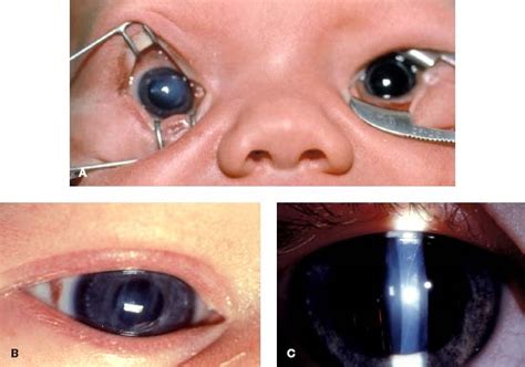 Congenital Corneal Opacity Ento Key