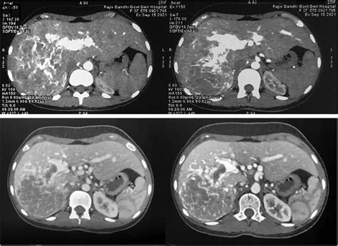 Multidetector Computed Tomography Axial Sections Showing A