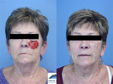 Facial Reconstruction Surgery Reno | Facial Reconstruction Surgeon Near Me