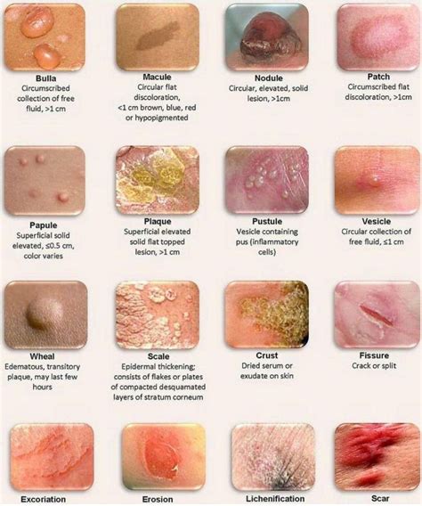 The Innovation Medicine On Twitter Different Types Of Skin Lesions