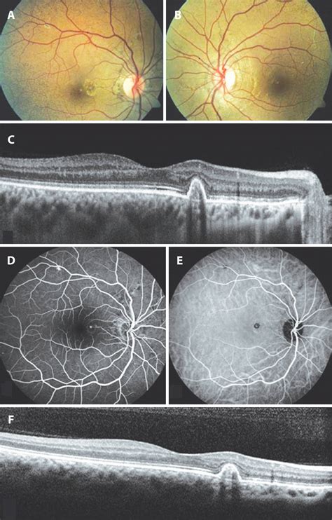 Angioid Streaks Of The Retina