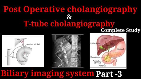 T Tube Cholangiogram