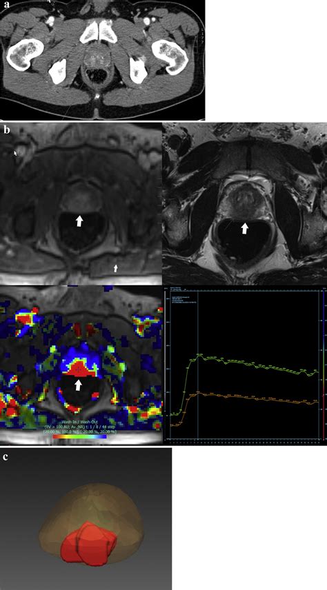 Prostate Cancer On Computed Tomography A Direct Comparison With Multi