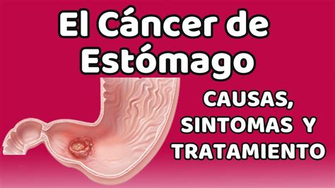 El CÁncer De EstÓmago Causas Signos Y Síntomas Diagnóstico Y Tratamiento Youtube