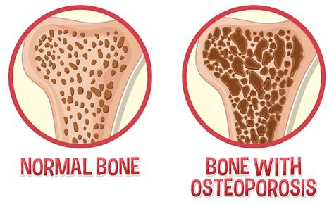 premium vector comparison  normal bone  bone  osteoporosis