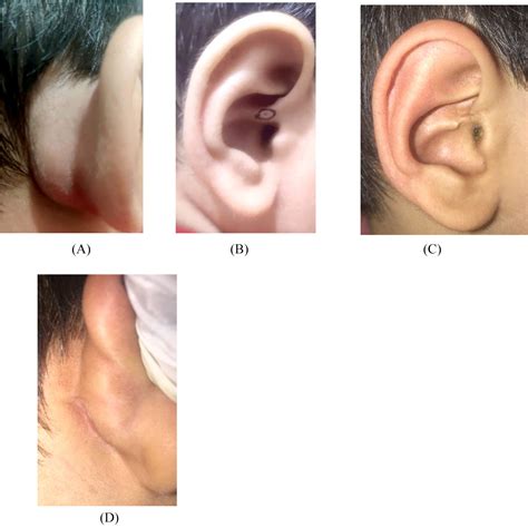 The Variant Type Of Preauricular Sinus With Recurrent Postauricular