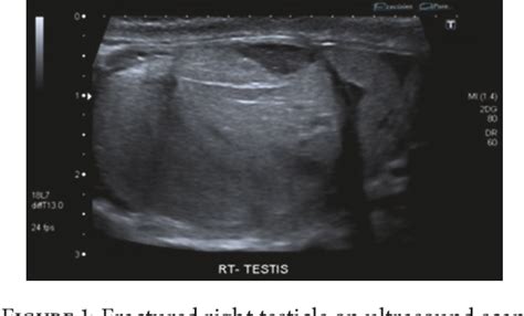 Figure From Testicular Rupture Or Testicular Fracture A Case Report