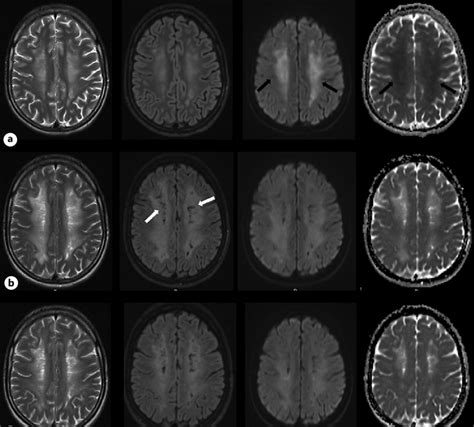 Serial Mri With T Flair And Dwi B Images Along With Adc Maps