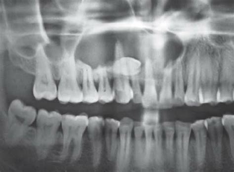 Panoramic radiograph showing supernumerary tooth in the cystic cavity ...