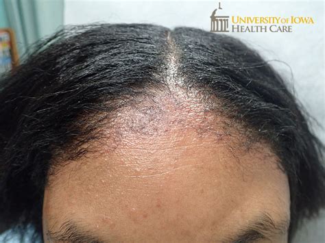 Erythematous papules with surrounding erythema on the frontal scalp. (click images for higher ...