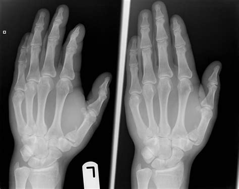 Bennetts Fracture Radiology Hand Therapy Fractures