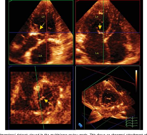 Figure 3 From Multiplanar Review Analysis Of Three Dimensional Echocardiographic Datasets Gives