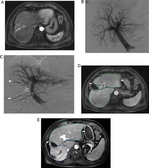 Image Guided Percutaneous Strategies To Improve The Resectability Of