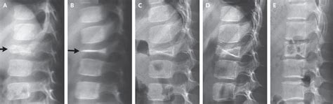 Vertebra Plana Sì, No. – Neurologia Funzionale, Chiropratica