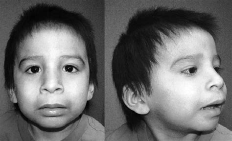 Typical Child With Fas The 3 Cardinal Facial Features Are Evident