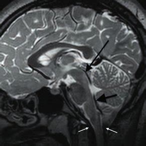 a). Normal sagittal T2-weighted MRI demonstrates CSF flow-related ...