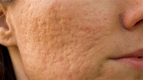 How To Get Rid Of Pitted Acne Scars