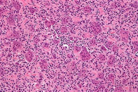 Histopathological image of bone biopsy | Download Scientific Diagram