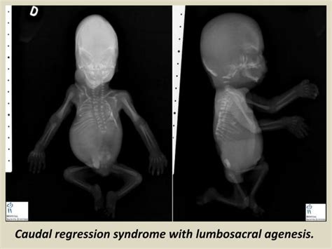 Presentation1 Radiological Imaging Of Caudal Regression Syndrome