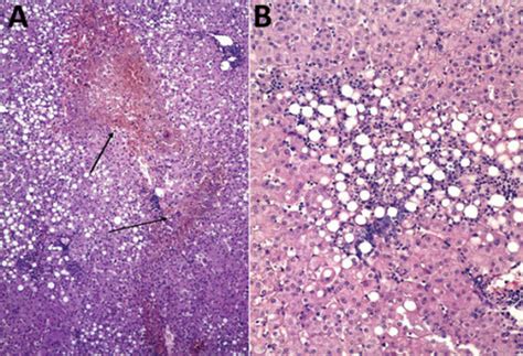 Human Monocytotropic Ehrlichiosis Wikiprojectmed