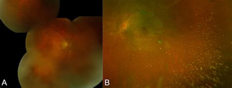 Asteroid Hyalosis An Update On Prevalence Opth