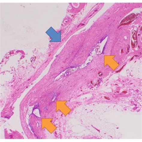 Ct Image Of Right Sided Hydrocele Of Canal Of Nuck Download