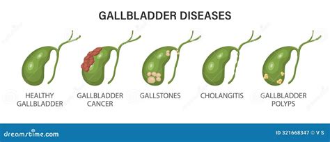 Gallbladder Diseases Infographics Gallstone Disease Cancer Acute