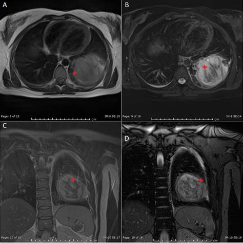 A Year Old Female With Biphasic Pulmonary Blastoma Technique Mri