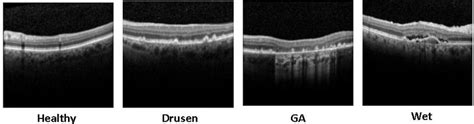 An Illustration Of Oct Images From Left To Right Healthy Drusen Ga