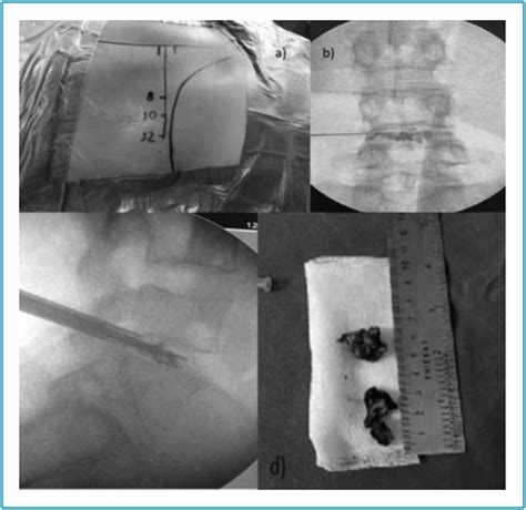 Scielo Brasil Comparison Of Two Endoscopic Spine Surgical