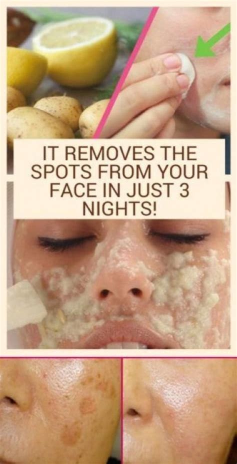 Pin By Kiara Thomas On Body Care In Brown Spots On Face Brown