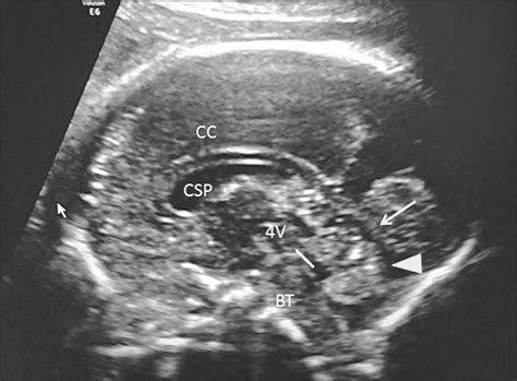 Scielo Brasil Ultrasonographic Evaluation Of The Fetal Central