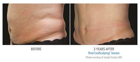 Coolsculpting Love Handles Woman Before And After Photos