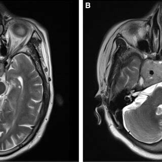 A B T2 Weighted Images Of Nonfunctional Pituitary Adenomas With Knosp