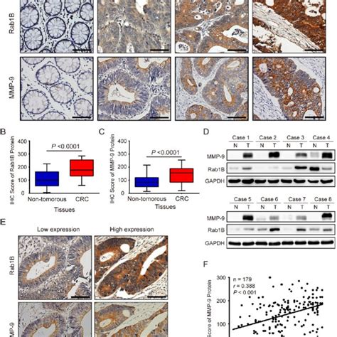 Rab B And Mmp Expressions Are Significantly Increased In Colorectal