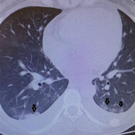 Chest Computed Tomography Showing Peripheral Patchy And Ground Glass