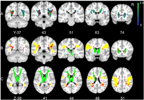 Voxel Based Lesion Symptom Mapping Results A Map Of The Correlation