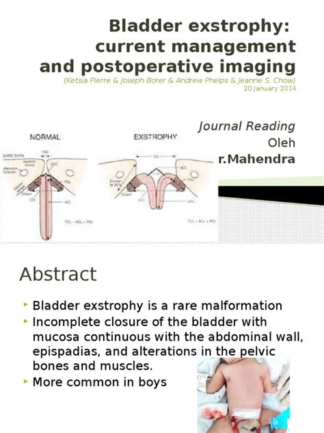 Bladder Exstrophy | Pelvis | Urinary Bladder