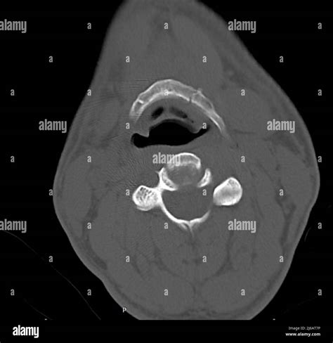 Fractured hyoid bone, CT scan Stock Photo - Alamy