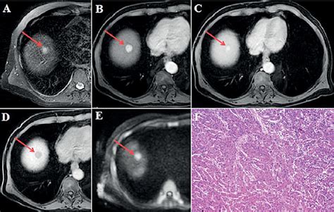 Hypervascular Hepatocellular Carcinoma Hcc Without Washout In Year