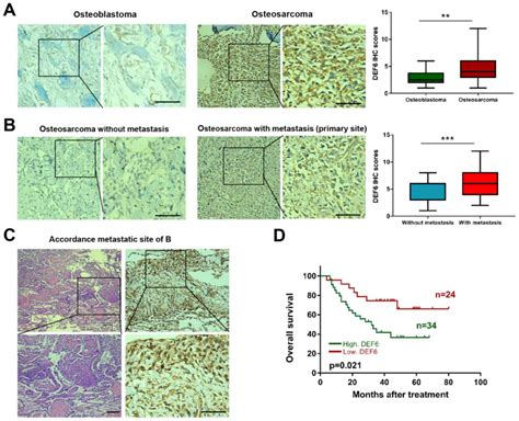 Increased DEF6 Expression Is Correlated With Metastasis And Poor