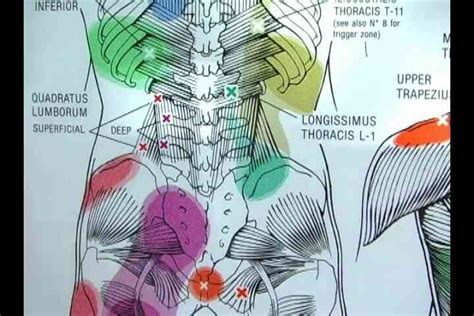 Quadratus Lumborum Trigger Point