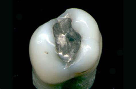 The Dangers of Mercury Amalgam Fillings in Teeth | Foundation for Alternative and Integrative ...